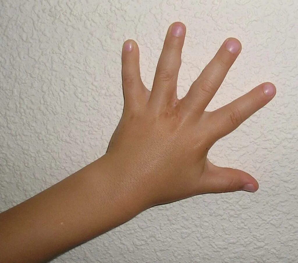 Перепонки между пальцами у мужчин. Брахидактилия синдактилия. Брахидактилия (короткопалость). Синдактилия пальцев кисти. Аплазия брахидактилия.