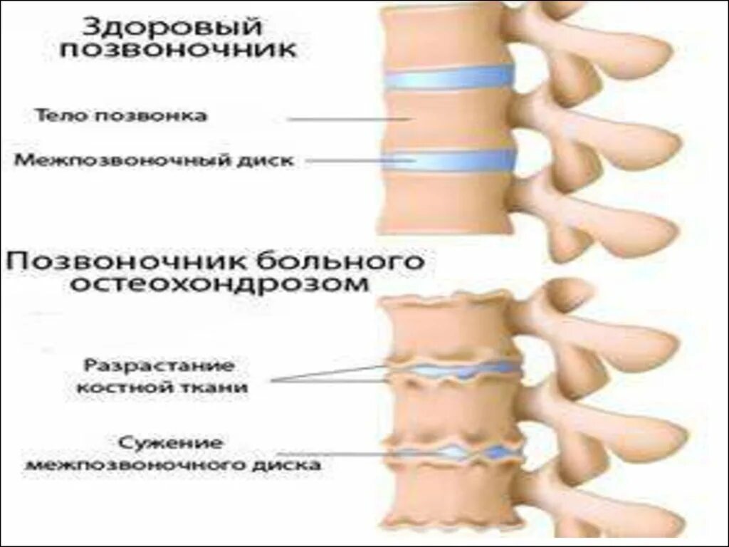 Остеохондроз поясничного отдела позвоночника периоды. Остеохондроз. Остеохондроз позвоночника. Остеохондроз позвоночника рекомендации. Здоровый позвоночник и нездоровый.