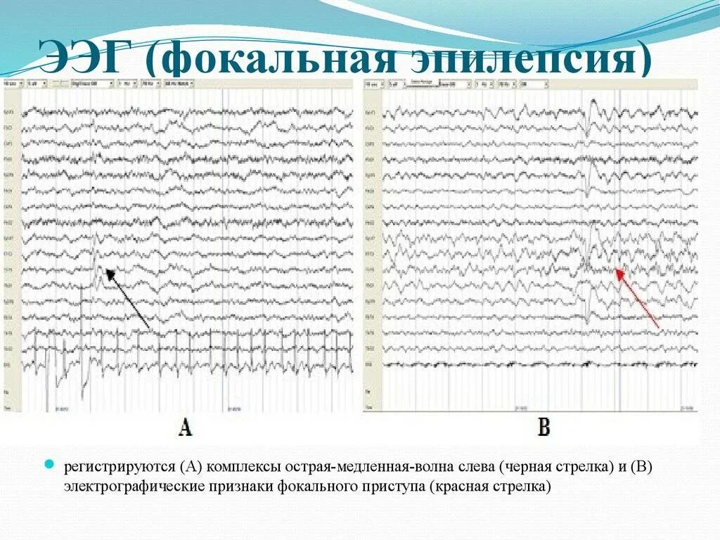 Ээг головного мозга что показывает. Генерализованная эпилепсия ээг. фокальная эпилепсия на ээг. ээг больного эпилепсией. ээг эпилепсия пик-волна.