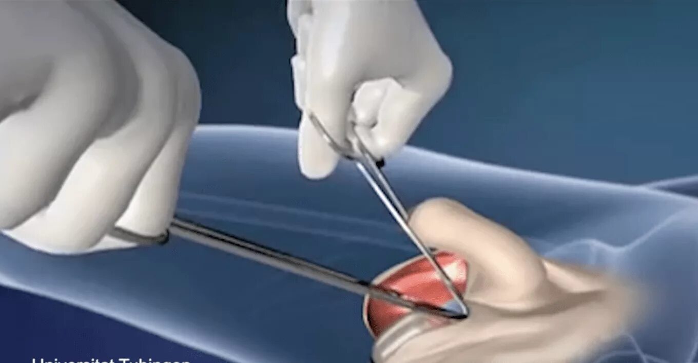 Lipofilling vulve - YouTube