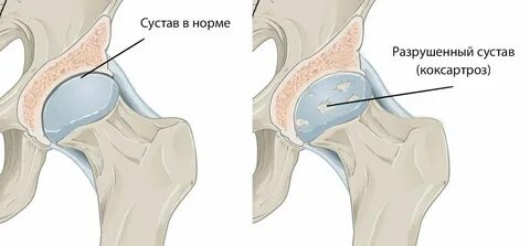 Лечение коксартроза тазобедренного сустава 3 степени препараты