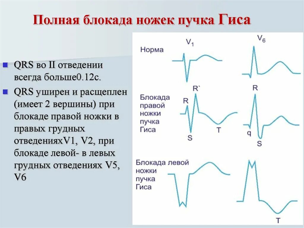 Диагноз блокада ножки гиса