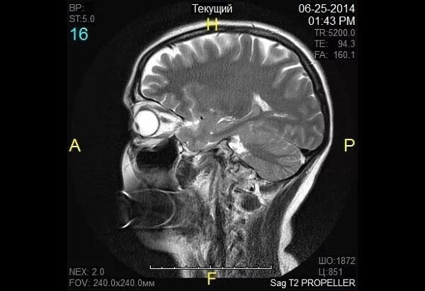 Магнитно-резонансная томография орбит. Мрт глазницы и зрительного нерва. Мрт головного мозга и орбит.