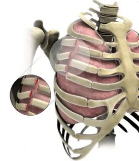 Broken ribs