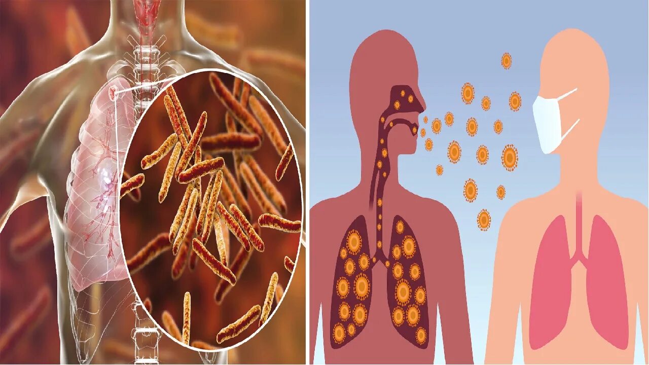 Палочка Коха туберкулез. Кох туберкулез. Палочка Коха Mycobacterium tuberculosis.