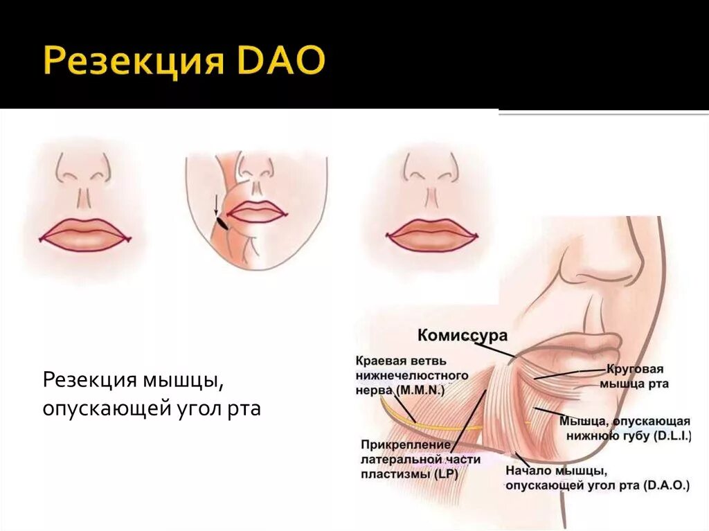 Резекция мышц опускающих угол рта. Что такое резекция Дао(мышц опускающих уголки рта). Резекция dao (мышцы, опускающей угол рта).