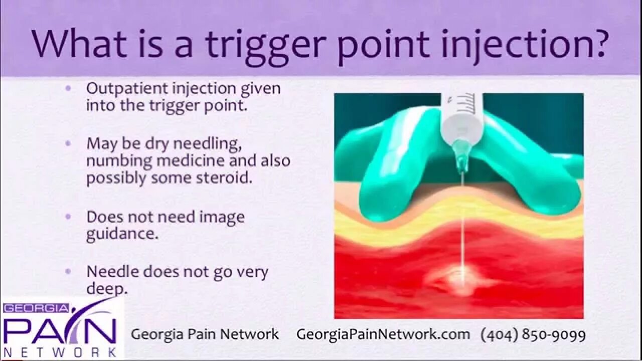 What is the trigger. Триггер поинт. trigger point pain patterns. trigger point упражнения болотов. триггер поинт шарики.