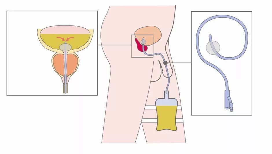 Канал мочи у мужчин. Цистостома катетер Фолея. Мочевой катетер Фолея. Катетер Фолея в мочевом пузыре. Катетер Фолея для мужчин.