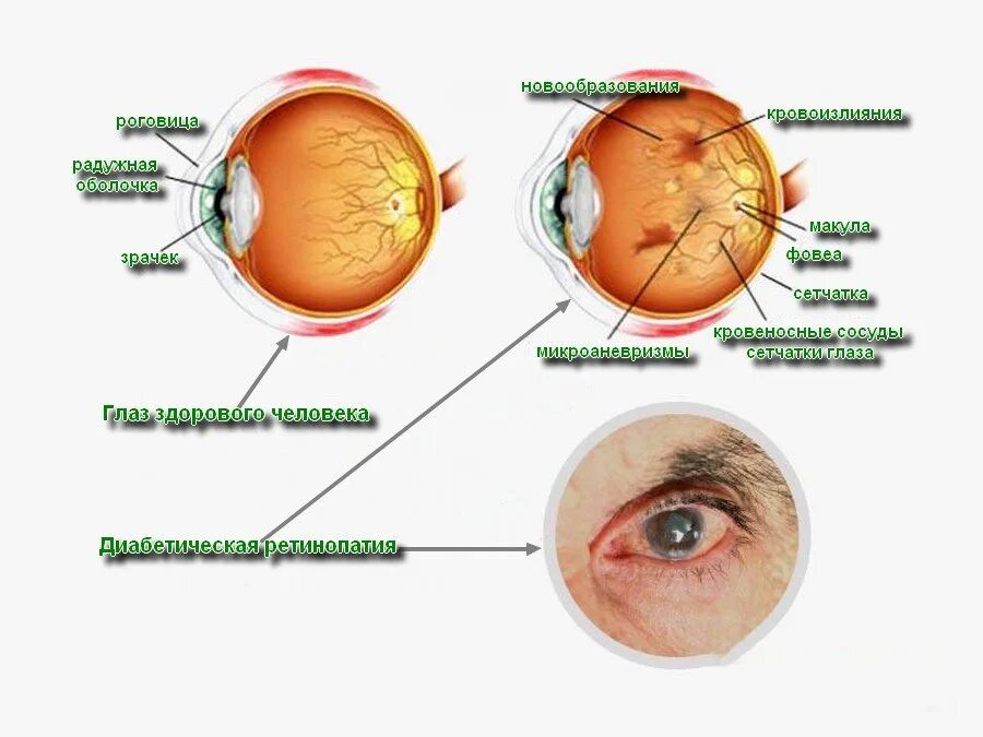 Прима макула. Патанатомия диабетической ретинопатии. Диабетическая ретинопатия изменения глазного дна. Диабетическая ретинопатия поражение сетчатки глаза. Симптомы при диабетической ретинопатии.