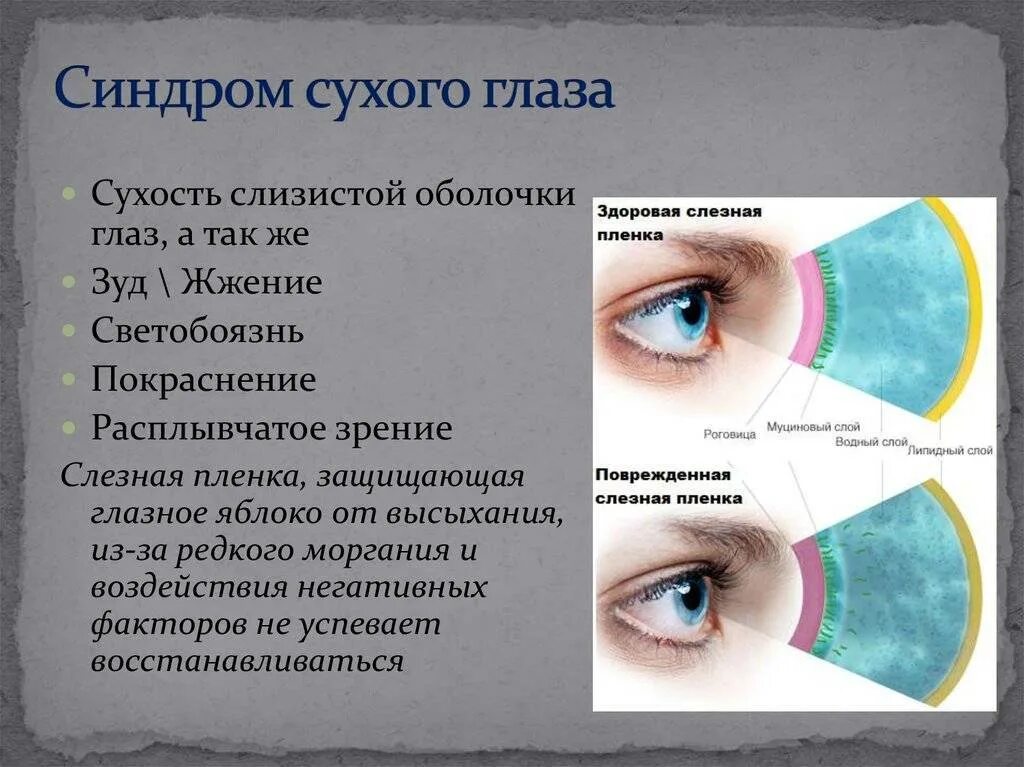 Можно ли вылечить синдром сухого. Синдром сухого глаза симптомы.