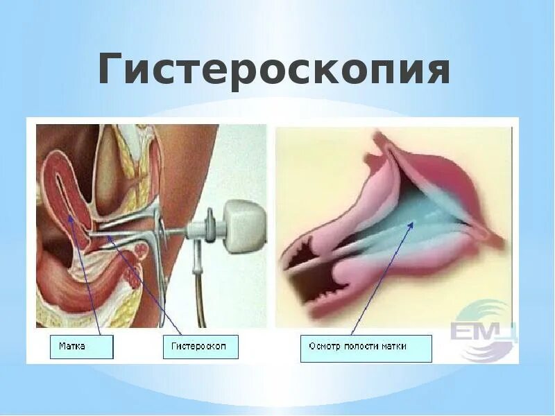 Гистероскопия и выскабливание матки. Осмотр матки в зеркалах двуручное исследование. Исследование с помощью зеркал в акушерстве. Ножевая биопсия шейки матки. Диагностическое выскабливание полости матки.
