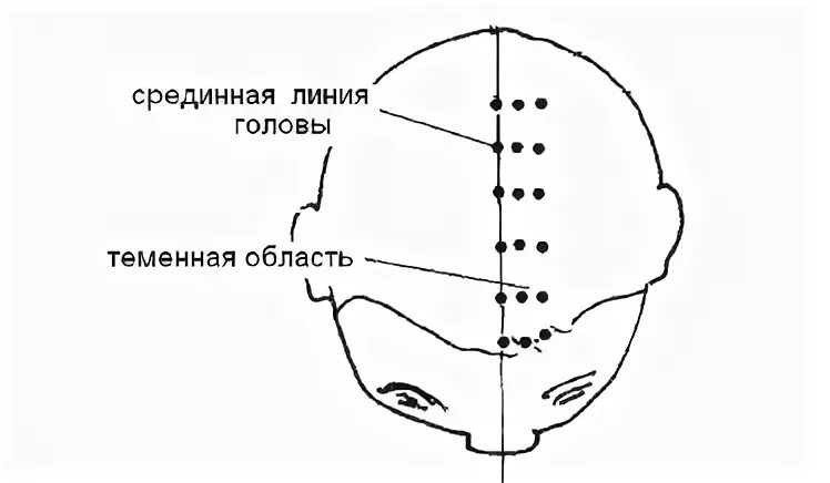 Линия затылка. Срединная линия головы. Выраженная линия головы. Битемпоральную линию головы. Часть головы от макушки до лба.