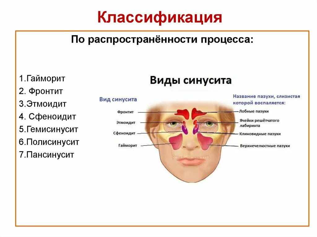 Синусит фронтит этмоидит. Гайморит фронтит этмоидит сфеноидит. Острый синусит классификация. Гемисинусит, сфеноидит.