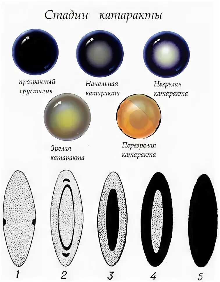 На начальных этапах хорошо. Классификация катаракты по степени зрелости. Классификация возрастной катаракты. Начальная старческая катаракта.
