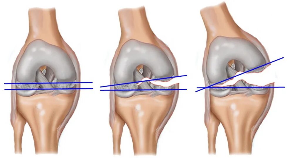 Повреждение коленной связки симптомы. Разрыв мениска и крестообразной связки. Крестообразные связки коленного сустава разрыв 1 степени. Разрыв связок ПКС коленного сустава. Разрыв связок и повреждение мениска.