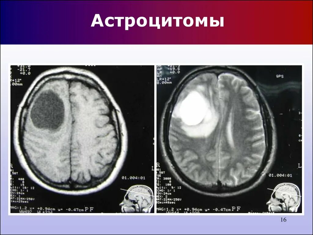 Злокачественная астроцитома гистология. Анаспластисеская ацитома. Астроцитома гистология. Анапластическая астроцитома головного мозга. Анапластическая астроцитома головного мозга.
