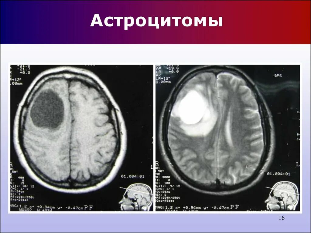 Глиобластома головного мозга мрт. Анапластическая астроцитома мрт. Диффузная астроцитома головного мозга мрт. Астрацетон головногомохга на мрт. Глиальная опухоль головного