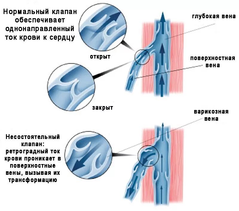 Венозный клапан нижних конечностей. Варикозное расширение вен патогенез. варикозное расширение вен клапаны. варикозное расширение вен нижних конечностей патогенез. варикоз нижних конечностей этиология.