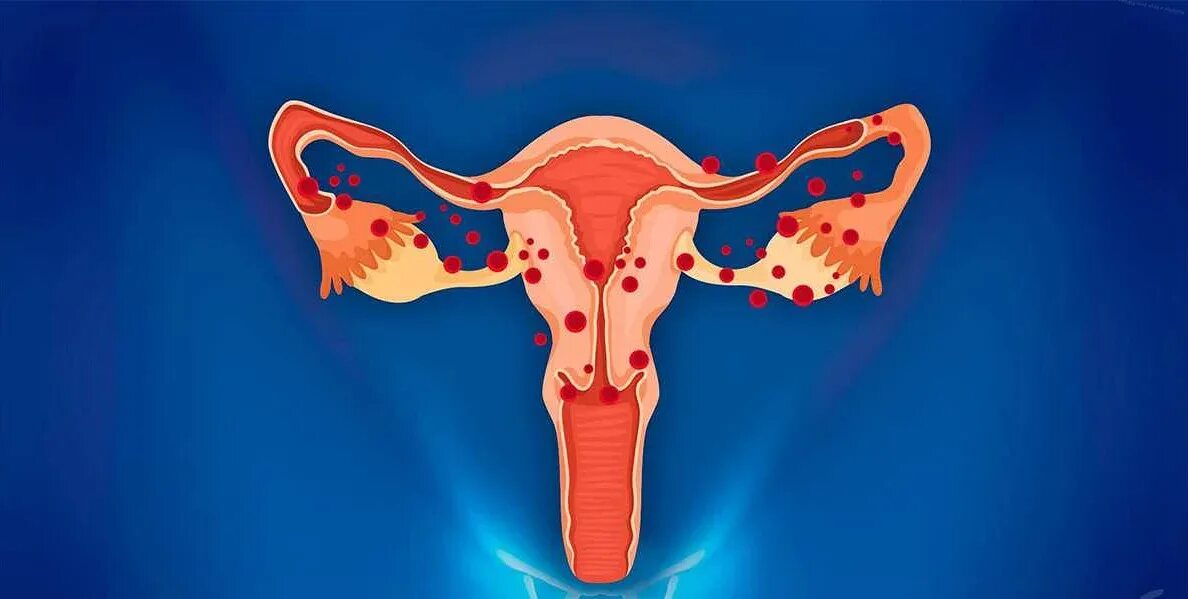 Сильно болят яичники во время месячных. Болит ли яичник при овуляции. Сильно болят яичники во время месячных. Жиры и репродуктивная система. Боль в правом яичнике после месячных.