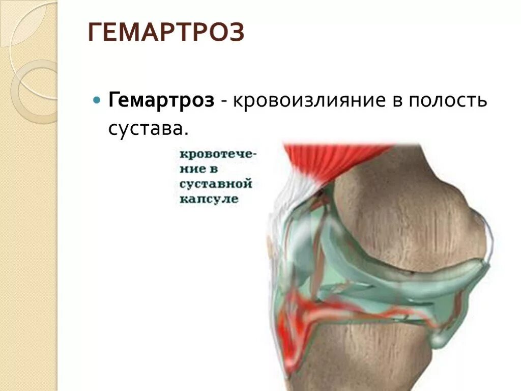 как лечить гемартроз