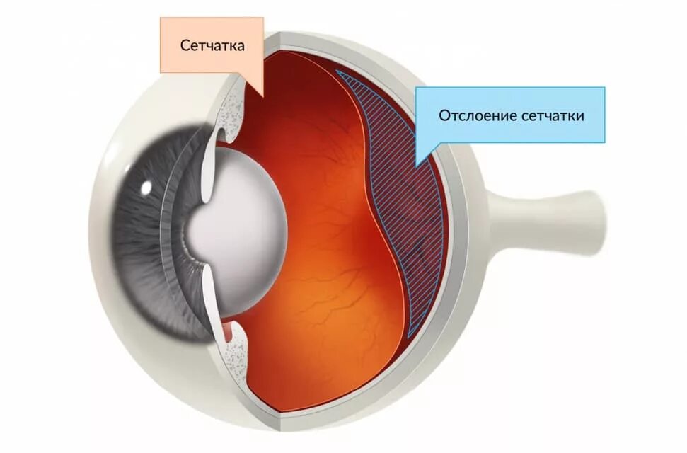 Отслойка сетчатки глаза. Отслоение глазной сетчатки. Повреждение сетчатки