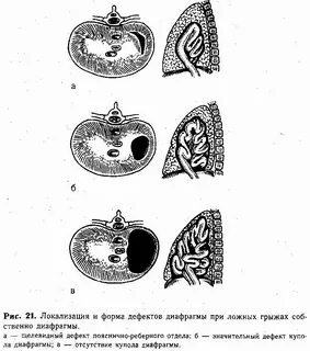 Истинные и ложные грыжи
