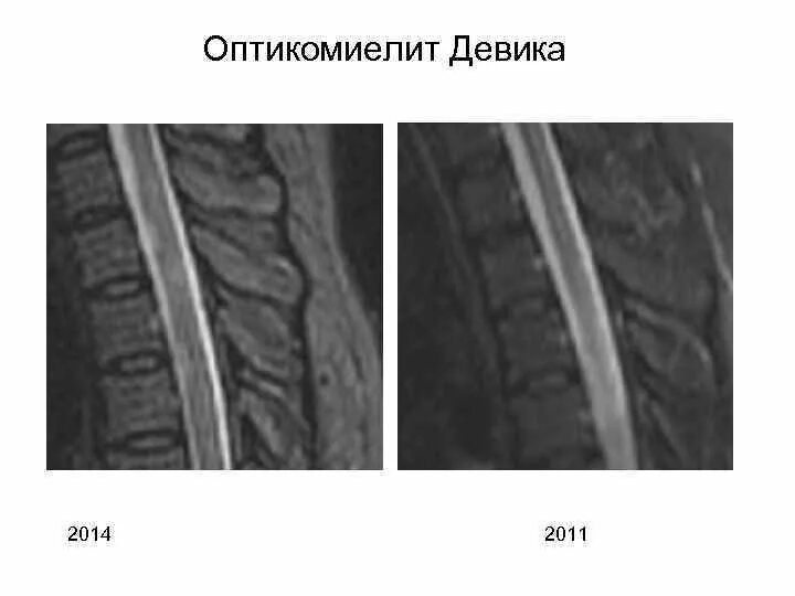 Оптиконевромиелит симптомы. Нейромиелит девика. Нейромиелит девика. Оптикомиелит девика клинические рекомендации. Оптикомиелит девика формулировка диагноза.