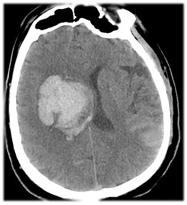 Геморрагический инсульт внутримозговая гематома. Внутримозговая гематома кт. Геморрагический инсульт кт. Субкортикальная гематома внутримозговая. Травматическое кровоизлияние