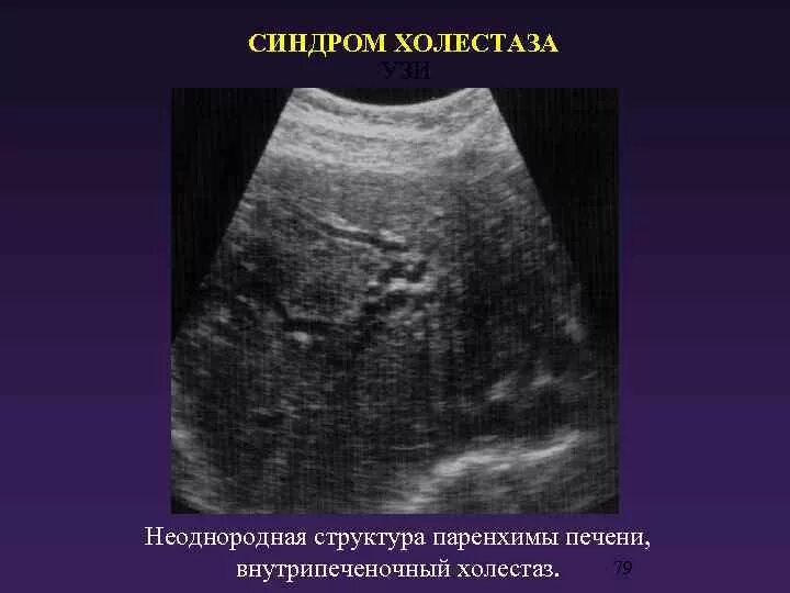 Печень диффузно неоднородная что это. Паренхима печени однородная. Неоднородная структура печени на УЗИ. Холестаз желчного пузыря УЗИ. Неоднородная паренхима печени УЗИ.