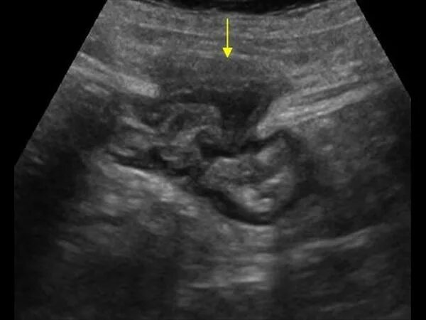 узи кишечника екатеринбург