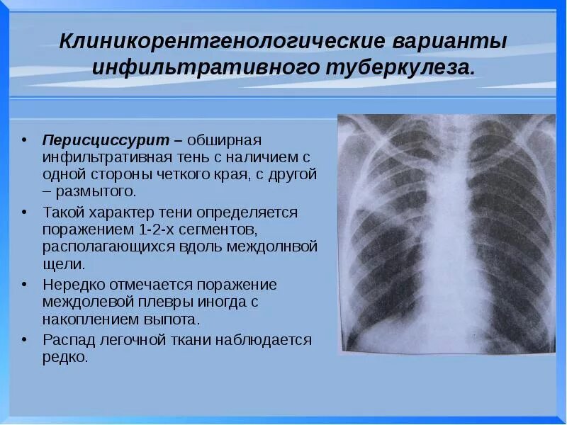 Инфильтративный туберкулез легкого рентген. Инфильтративный туберкулез синдромы рентген. Перисциссурит туберкулез рентген. Рентген картина инфильтративного туберкулеза. Без очаговых и инфильтративных изменений
