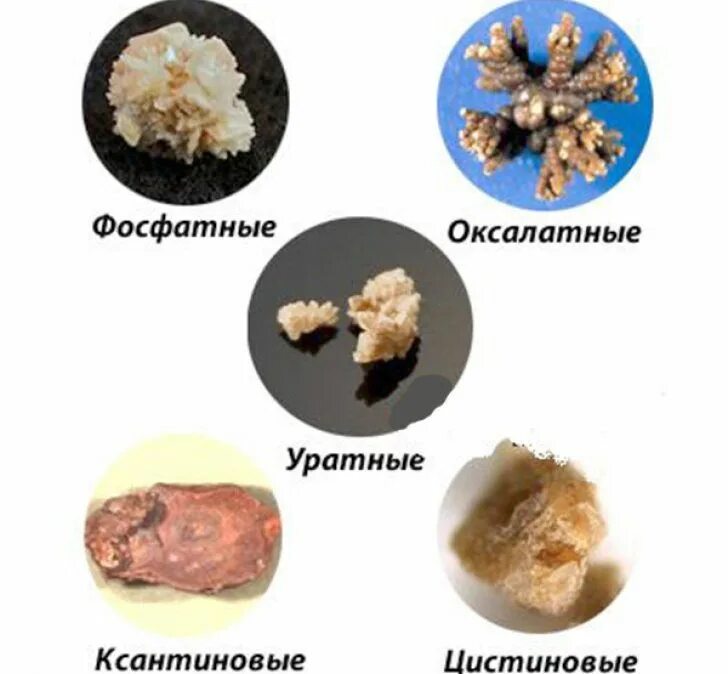 Разновидности камней в почках. Классификация камней при мочекаменной болезни. Оксалатные камни в почках вид. Ураты фосфаты оксалаты мочекаменная болезнь.