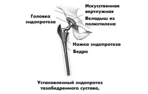 Причина боли после эндопротезирования