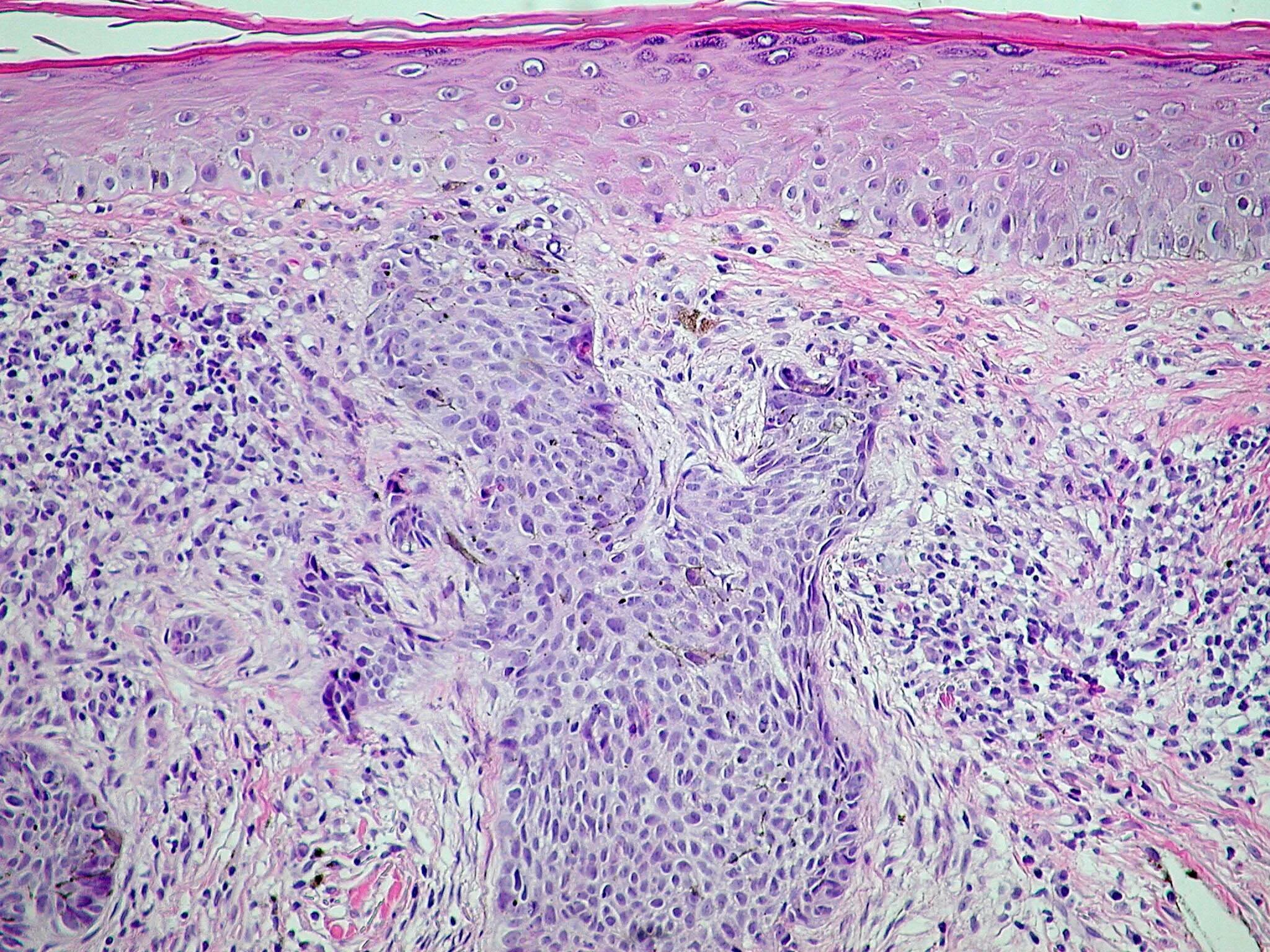 Гистология базалиома. Базальноклеточная карцинома гистология. squamous cell carcinoma гистология. базалиома кожи гистология.