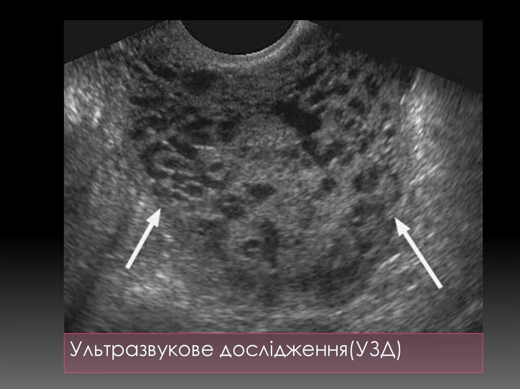 Эндометрии в полости. Трофобластическая болезнь УЗИ. Плодное яйцо трансабдоминально.