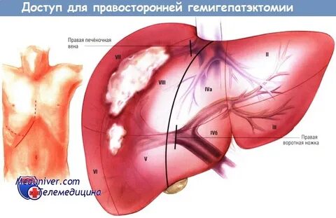 Удаление печени операция