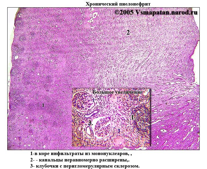 Пиелонефрит микропрепарат. Геойный пиелонефрит микро. Хронический пиелонефрит микропрепарат. Хронический пиелонефрит патанатомия препарат. Хронический нефрит микропрепарат.