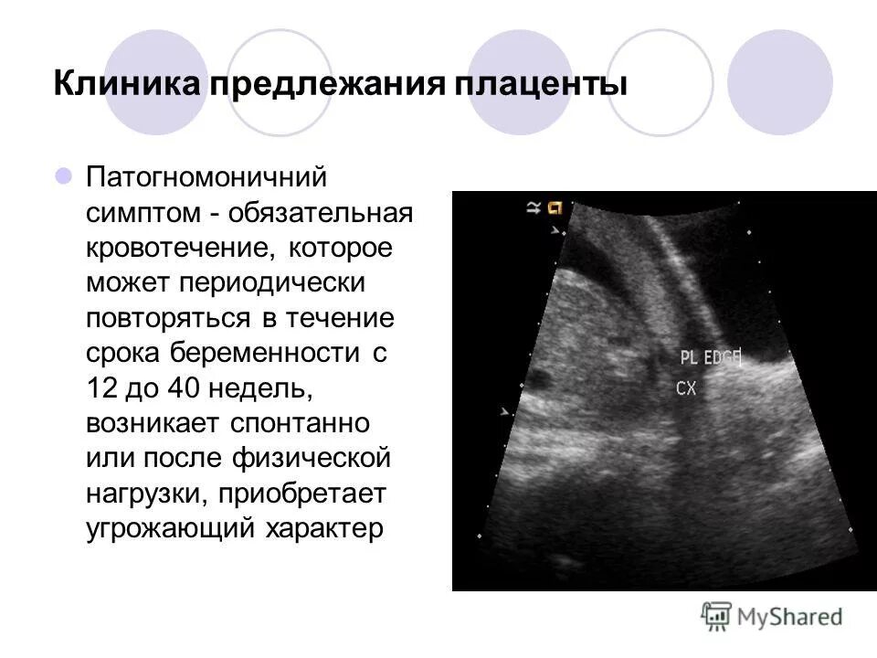 Предлежание плаценты. Переднее предлежание плаценты при беременности 12 недель. Что такое краевое предлежание хориона при беременности. При центральном предлежании плаценты. Краевое предлежание плаценты хориона.