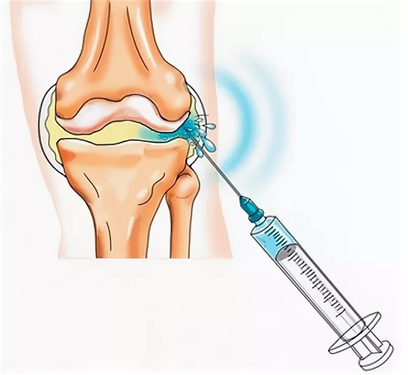 Введение дипроспана в коленный сустав. Техника внутрисуставной инъекции в коленный сустав. Внутрисуставные блокады коленного сустава. Блокада для суставов Дипроспан. Укол дипроспана в коленный сустав