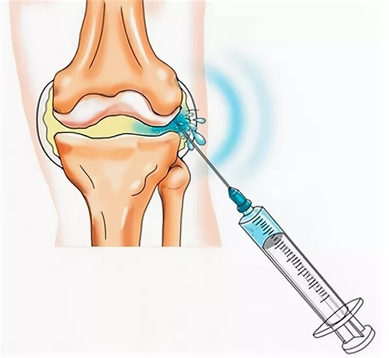 Укол дипроспана в коленный сустав