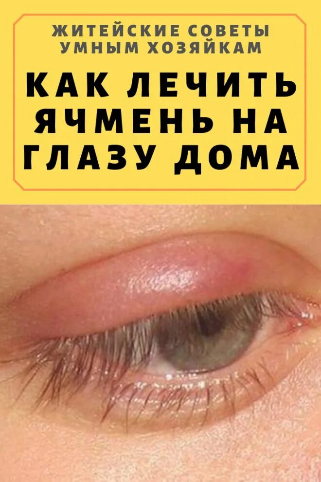 Как избавиться в домашних условиях от ячменя. Я чмень на глощу.