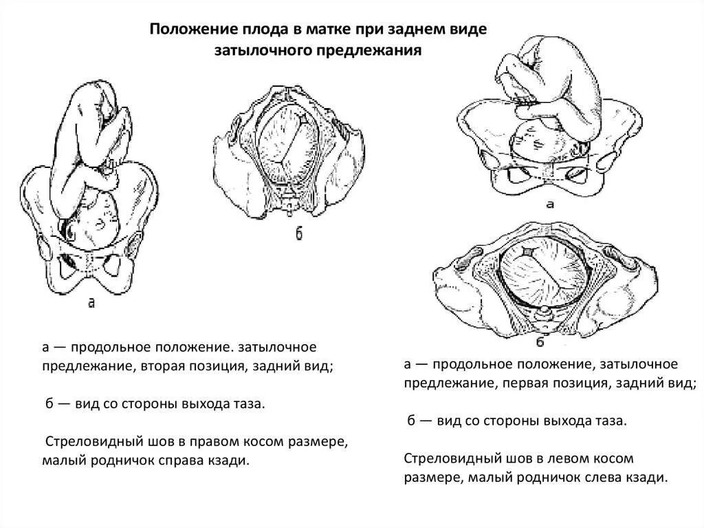 Как определить в каком положении находится. Положение ребёнка при головном предлежании. Как определить вид позиции плода. Как определить положение позицию и вид плода. Положение плода продольное предлежание тазовое.