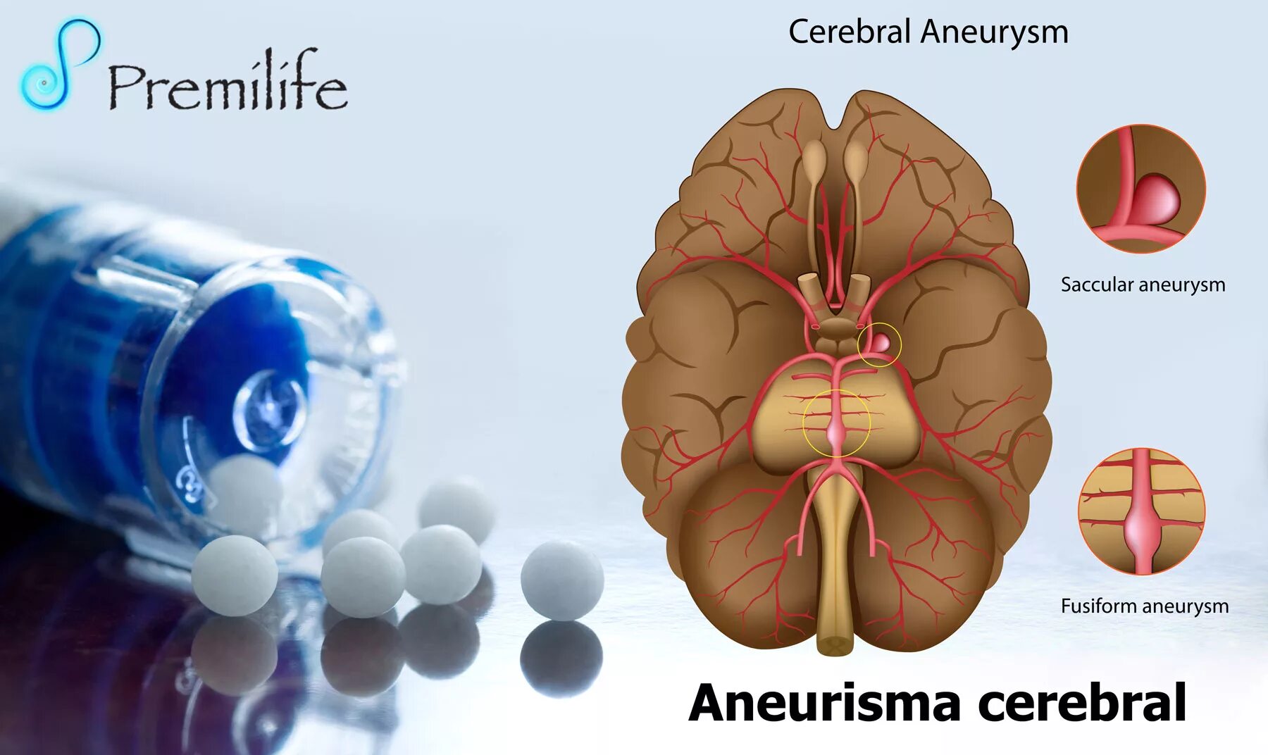 Аневризме головного мозга. Аневризм сосудов головного мозга. Артериальные аневризмы сосудов головного мозга.
