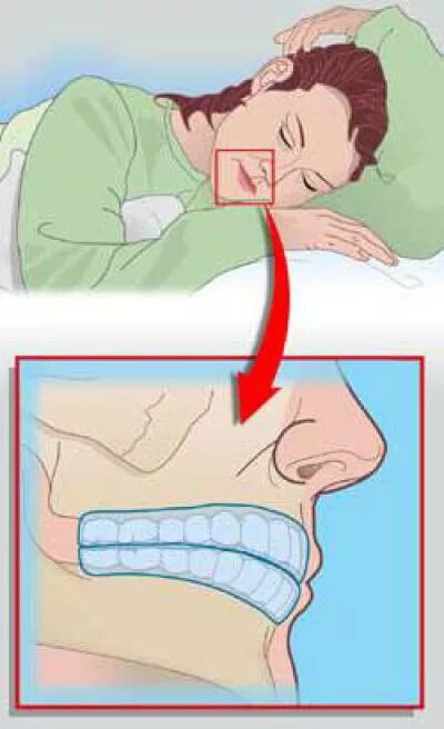 Спать с открытым ртом причины. Скрежет зубами по ночам. Скрежет зубами во сне причины. Положение челюсти во сне.