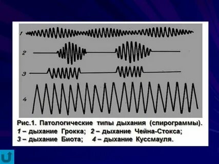 Патологические типы дыхания