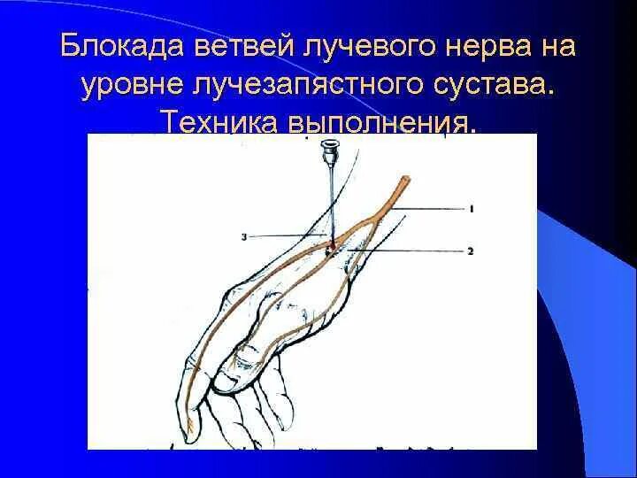 Нервная блокада. Проводниковая анестезия локтевого срединного нерва. Проводниковая блокада локтевого нерва. Блокада локтевого нерва на кисти. Проводниковая блокада срединного нерва.