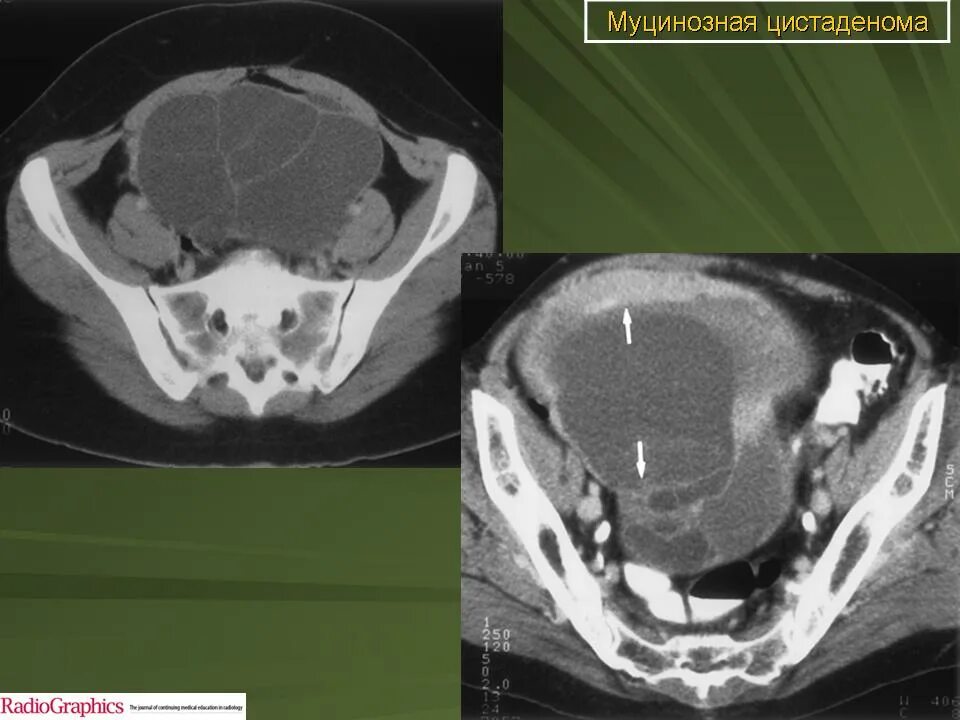 Муцинозные опухоли яичников. Папиллярная цистаденома мрт. Цистаденома поджелудочной железы кт. Цистаденофиброма яичника мрт.