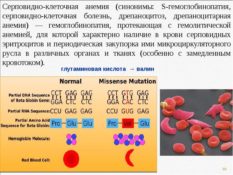 Ген серповидноклеточной анемии. Серповидноклеточная Тип наследования. Тип наследования серповидно-клеточной анемии. Серповидная анемия эритроциты. Серповидноклеточная анемия кариотип больного.
