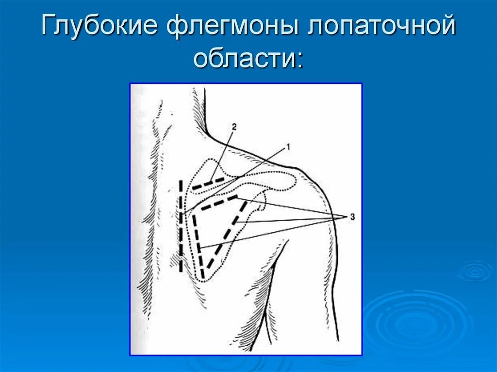 Распространение флегмоны. Разрезы при субпекторальной флегмоне топографическая анатомия. вскрытие субпекторальной флегмоны.
