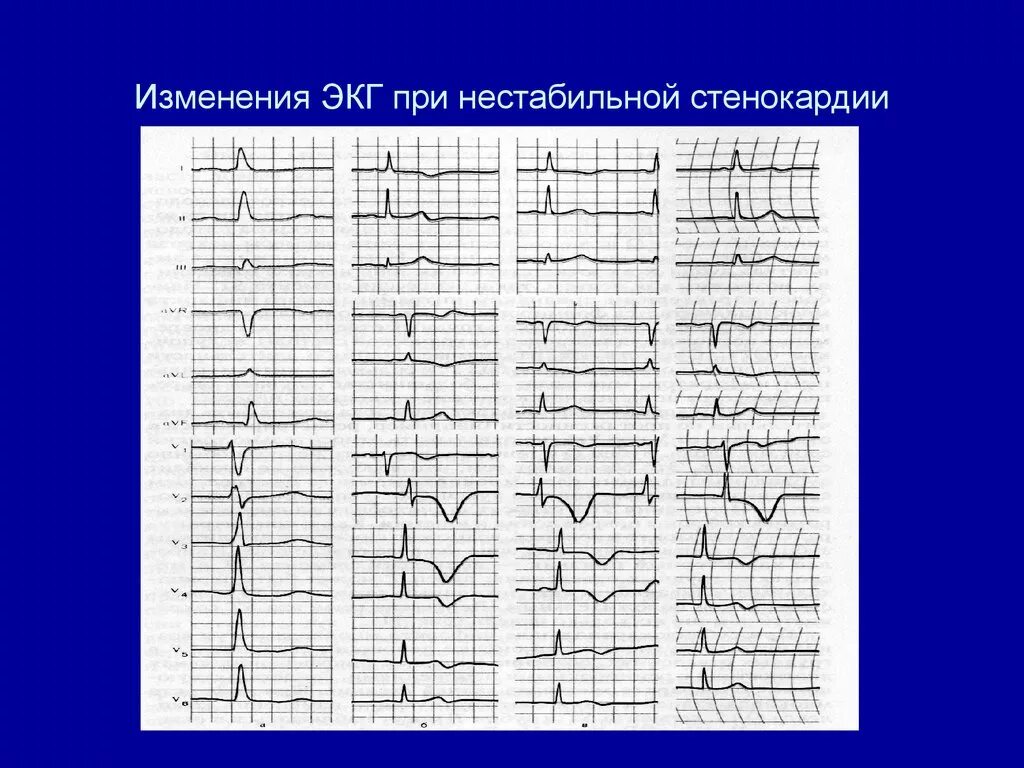 Ишемия боковой стенки. ЭКГ при нестабильной стенокардии. Прогрессирующая стенокардия ЭКГ. ЭКГ признаки стенокардии напряжения. ЭКГ при ИБС стенокардия напряжения.